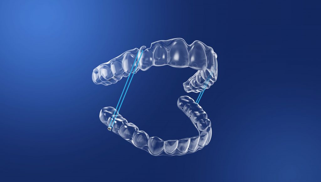 Zenyum clear aligners with elastics and attachments