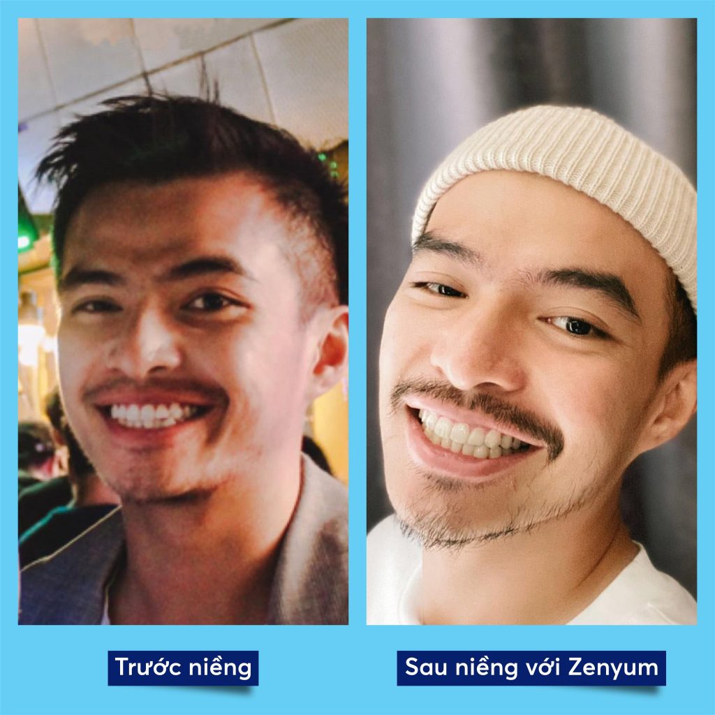 Hình ảnh trước và sau khi niềng răng móm