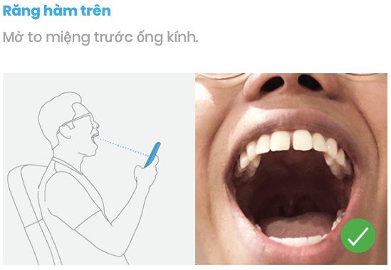 cách chụp ảnh răng hàm trên