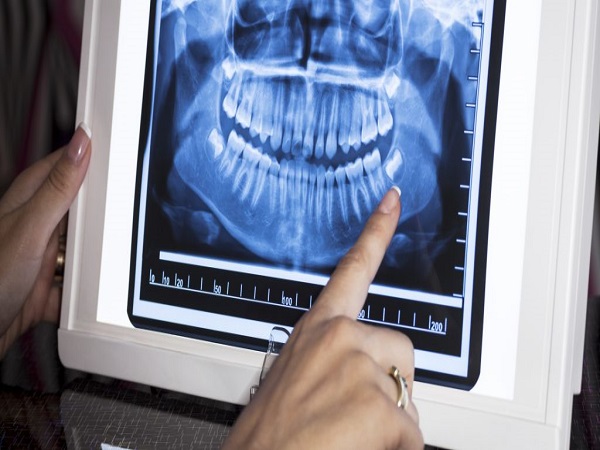 Cách để nhận biết răng móm là gì?