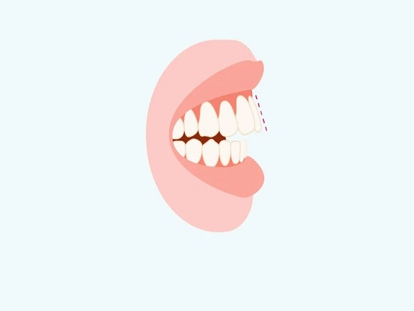 Răng bị hô hàm trên có niềng được không?