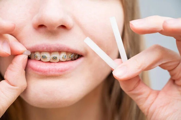 Dùng sáp nha khoa giảm đau khi niềng răng