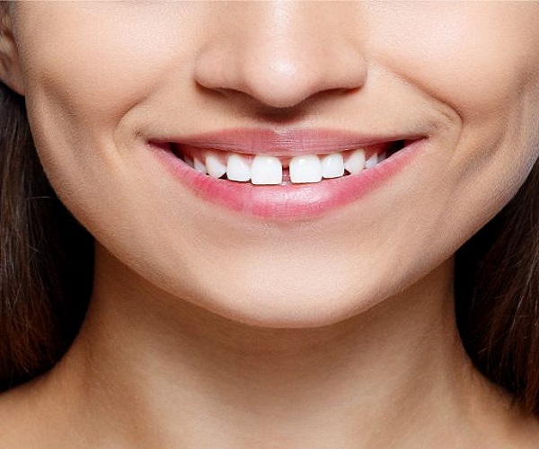 Niềng răng hàm dưới có thể áp dụng cho đối tượng bị răng thưa