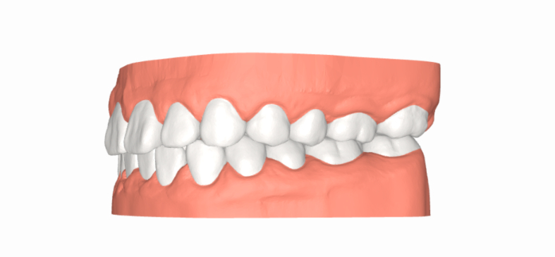 Có nên niềng răng không còn tùy thuộc vào tình trạng răng miệng, khung hàm của mỗi người