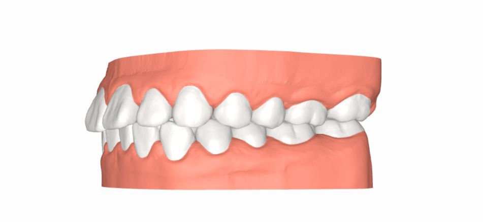 niềng răng 1 hàm cho răng hô