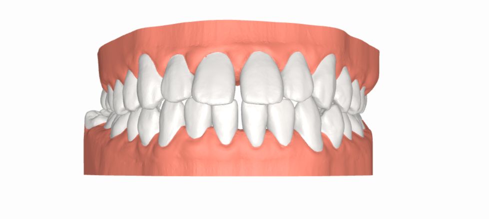 niềng răng 1 hàm cho răng thưa