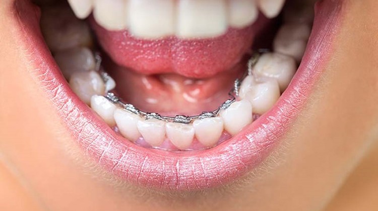 niềng răng 1 hàm