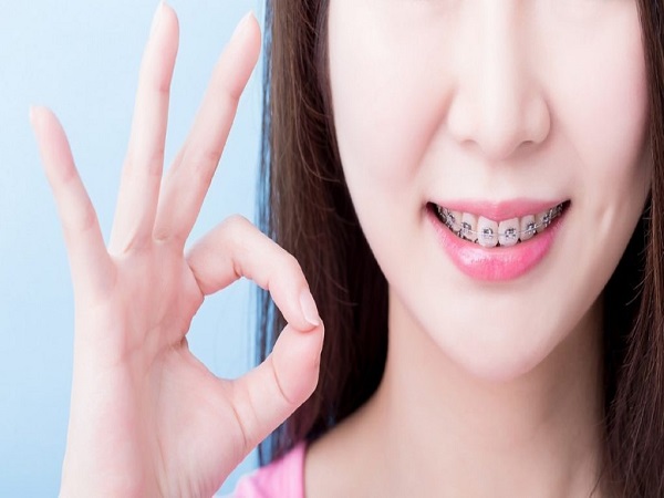 Niềng răng hàm trên mất bao lâu mới có hiệu quả?