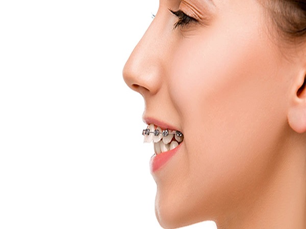 Tình trạng răng hô nhẹ là như thế nào?