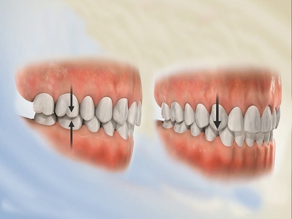 Những trường hợp nào niềng răng không nhổ răng?