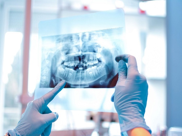 Chụp X-quang là bước không thể thiếu để thực hiện niềng răng đúng kỹ thuật.