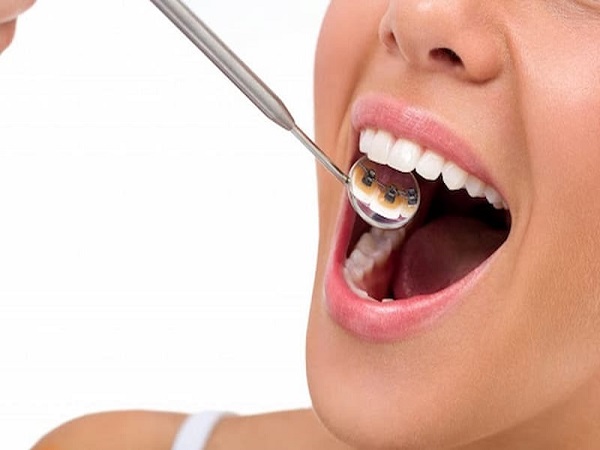 Niềng răng mắc cài mặt trong có tính thẩm mỹ cao bởi phần mắc cài được gắn vào mặt trong của răng thay vì ở mặt ngoài như các phương pháp khác