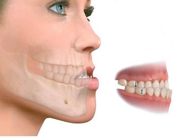 Răng móm hay còn gọi là khớp cắn ngược, là tình trạng thường gặp tại nha khoa 