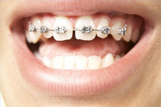 Niềng răng thưa với niềng răng mắc cài kim loại là phương pháp được sử dụng phổ biến