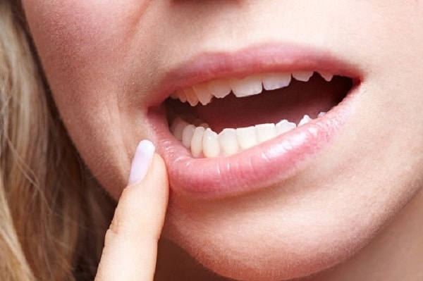 tình trạng răng ảnh hưởng đến giá niềng răng