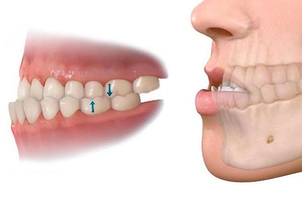 Ảnh hưởng của răng móm