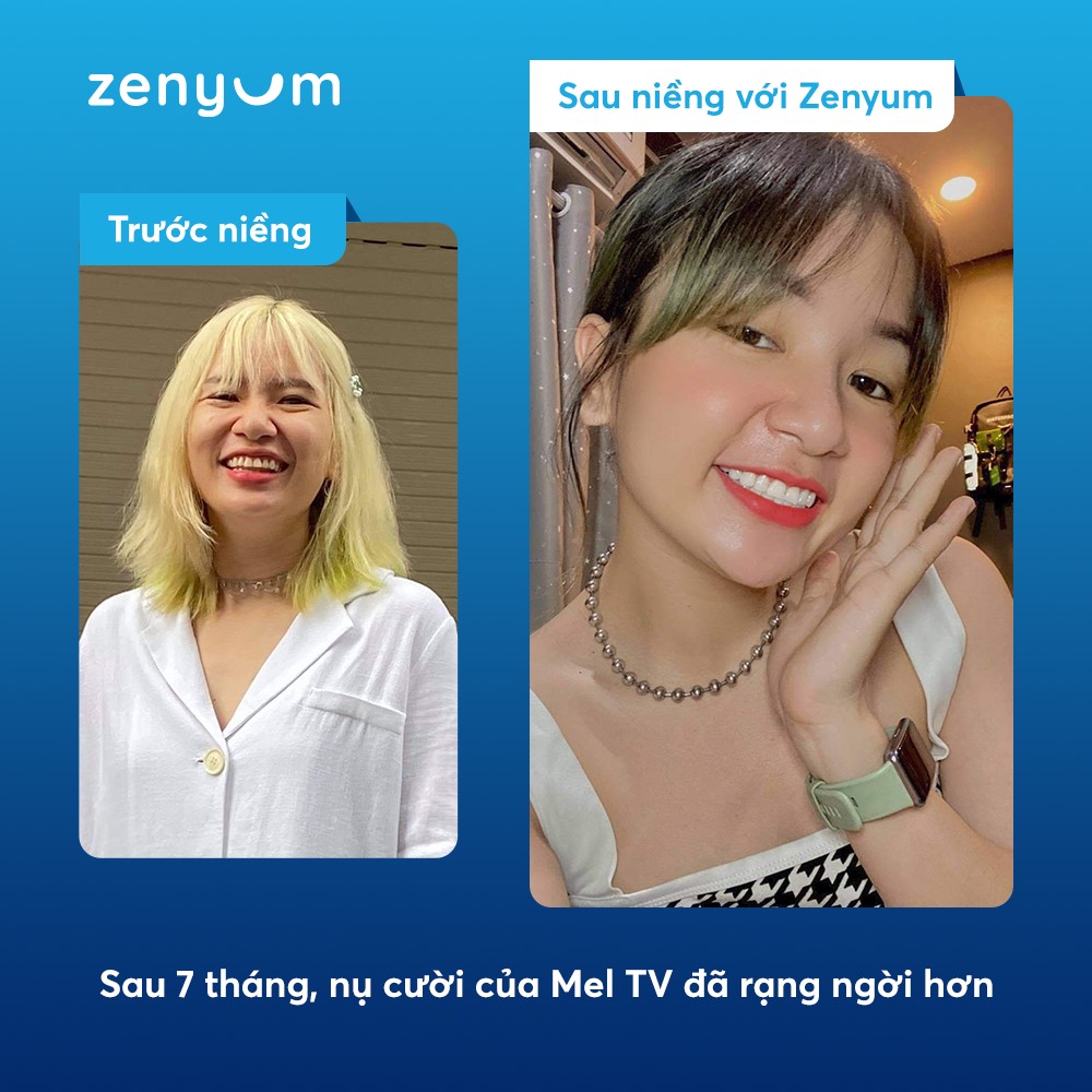Sự thay đổi rõ rệt trước và sau khi niềng răng trong suốt Zenyum của KOL Mel TV