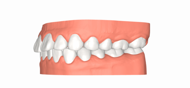 Niềng răng cho các trường hợp răng hô, vẩu có thể mang lại hiệu quả thẩm mỹ vượt trội cho khuôn mặt.