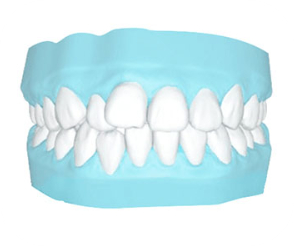 Răng khấp khểnh là tình trạng răng mọc không đều, chen chúc nhau trên khuôn hàm