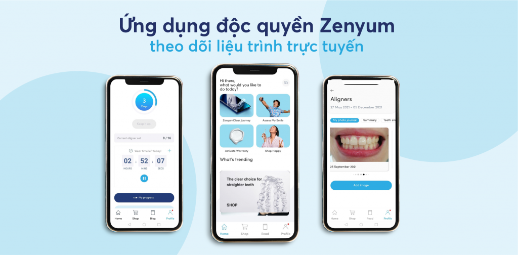 Toàn bộ quá trình niềng răng được theo dõi và cập nhật qua ứng dụng thông minh độc quyền Zenyum, tiết kiệm tối đa thời gian thăm khám.
