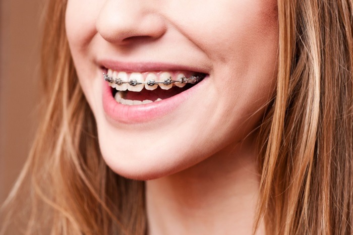 Niềng răng mắc cài là hình thức chỉnh nha phổ biến, được sử dụng nhiều tại các nha khoa