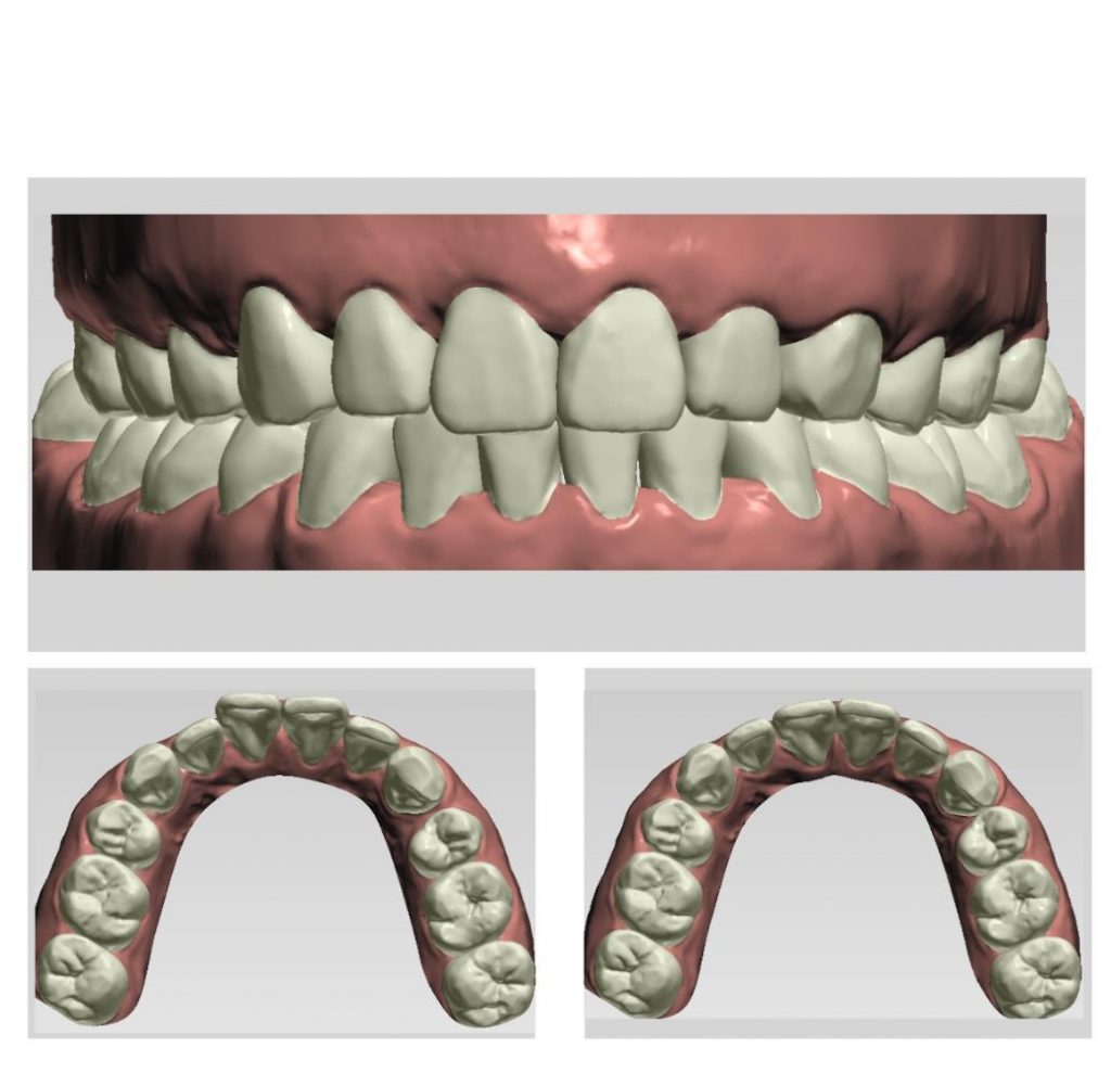 Với mô phỏng 3D hiện đại, khách hành so sánh, quan sát được sự dịch chuyển của răng sau khi niềng