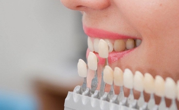 Bọc răng sứ chỉ phù hợp với tình trạng răng thưa nhẹ hoặc bị mẻ
