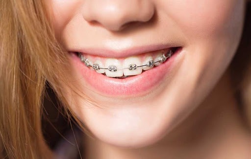 Niềng răng mắc cài là phương pháp phổ biến, phù hợp với hầu hết các khiếm khuyết răng.