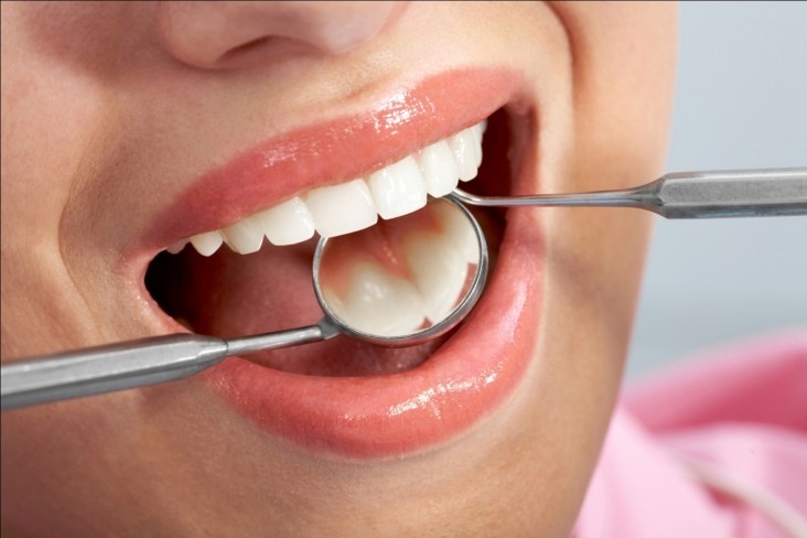 Trám răng áp dụng cho các trường hợp răng bị thưa có khoảng cách dưới 2mm