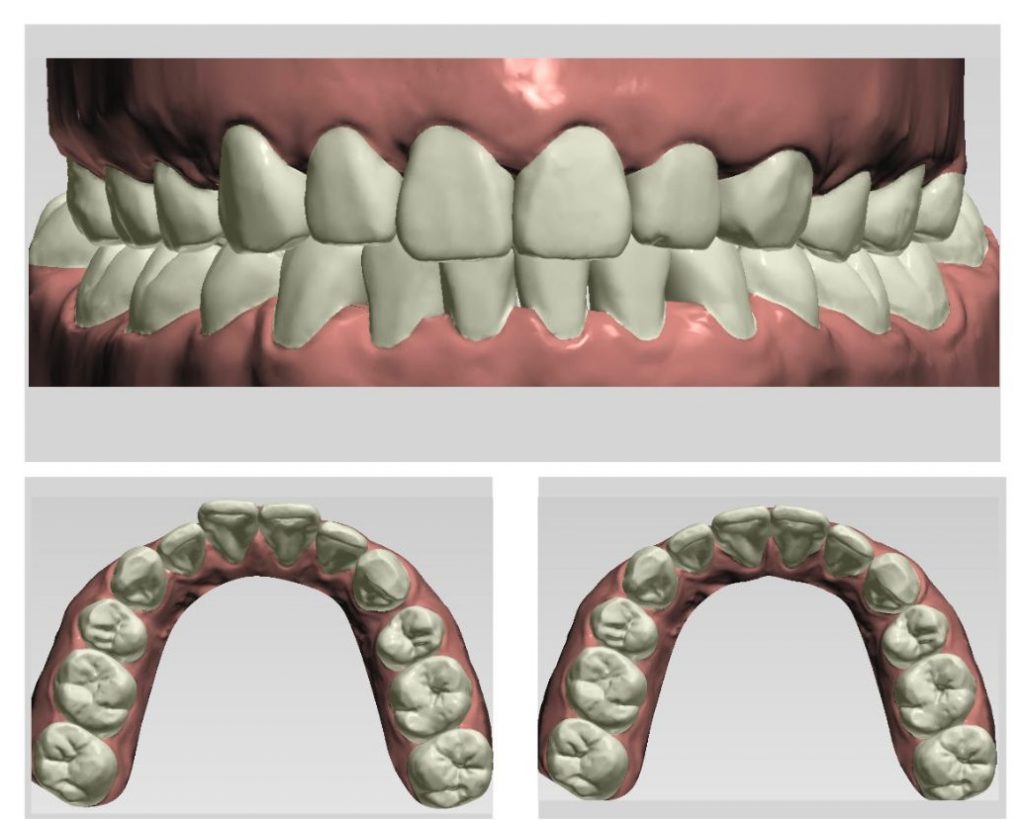 Các bác sĩ sẽ dựa trên hình ảnh mô phỏng 3D quá trình dịch chuyển răng đề thiết kế khay niềng cho từng trường hợp.
